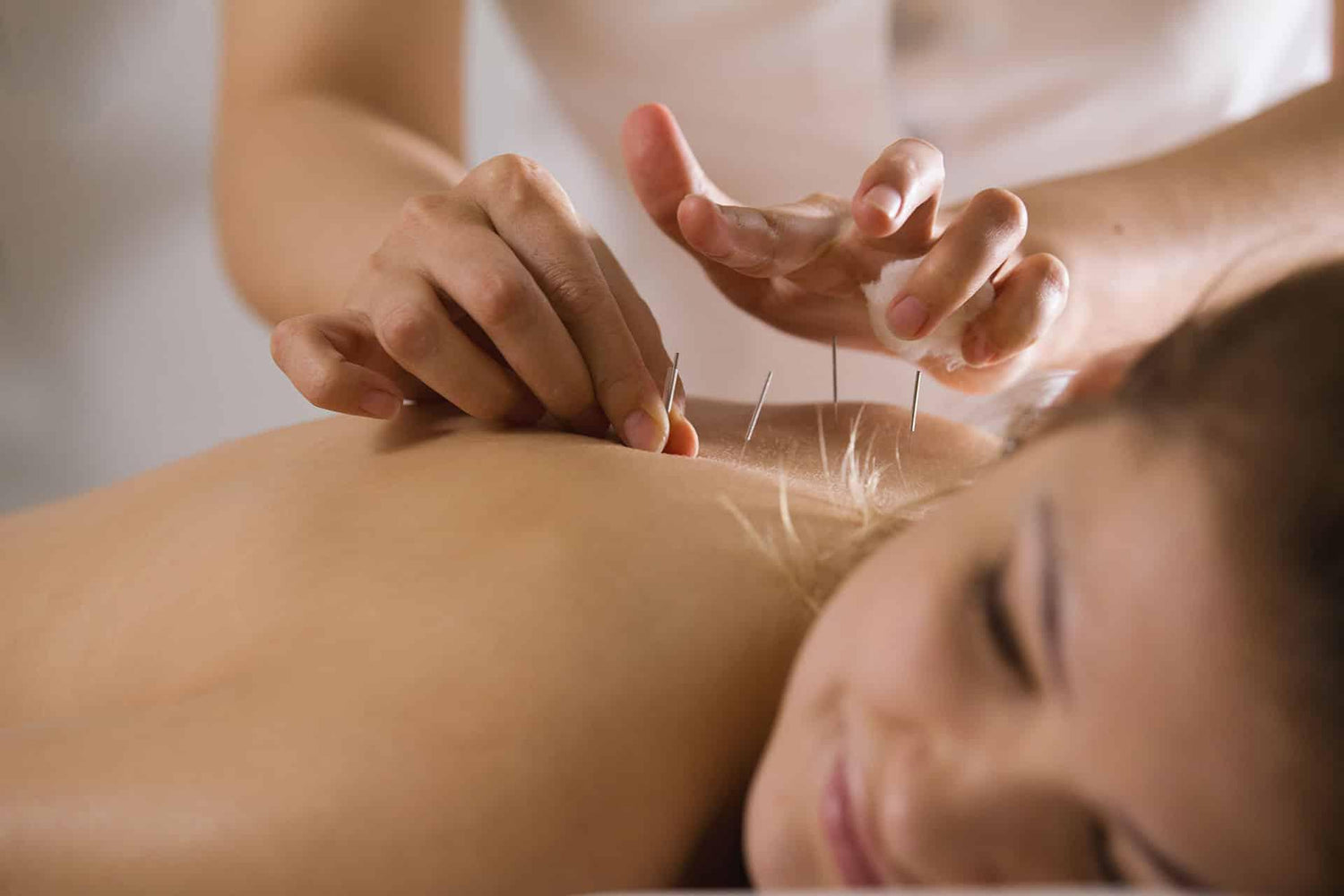 Closeup of woman receiving acupuncture